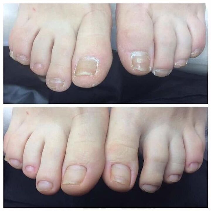 pregled korištenja Exodermin