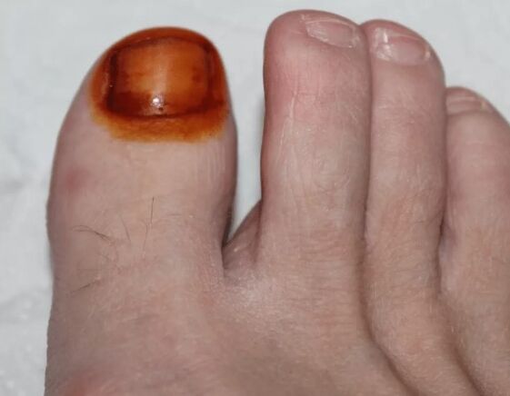 Liječenje joda s gljivama