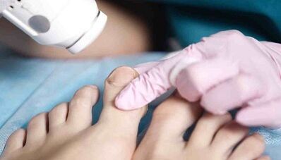 Hardver tretman gljiva na nogama