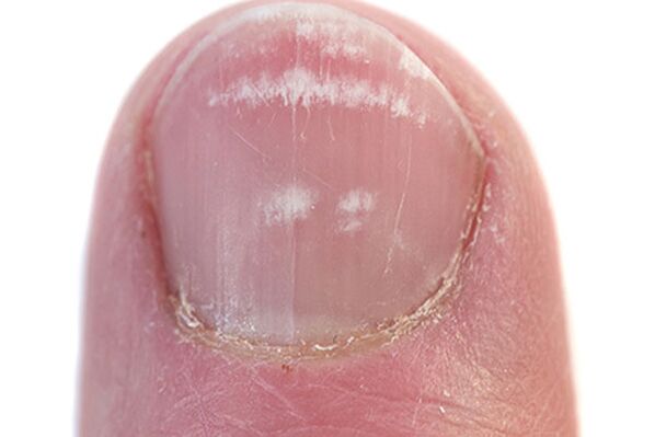 Prvi znakovi i simptomi