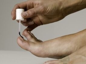 Tretman gljiva noktiju