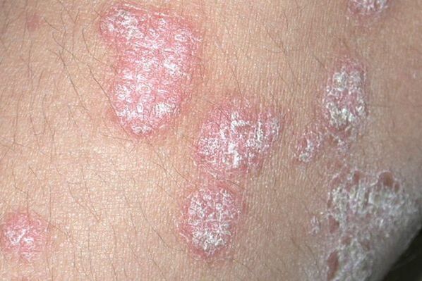 Psorijaza uzrokovana gljivičnom infekcijom