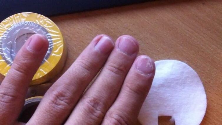 gljiva noktiju i njegovo liječenje narodnim lijekovima